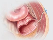 Biodesign® Enterocutaneous Fistula Plug
