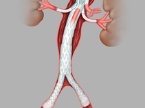 Zenith® Universal Distal Body Graft in Anatomy
