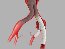 Zenith® Iliac Branch in anatomy