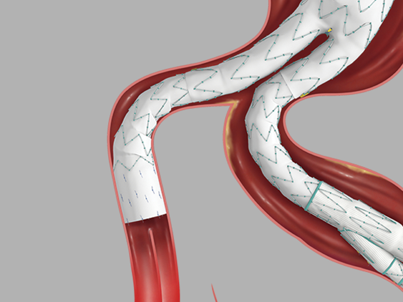 Zenith Alpha™ Spiral-Z Endovascular Leg in Anatomy
