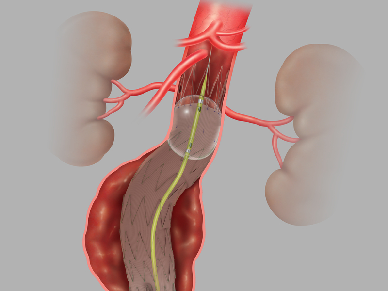 Coda® Balloon Catheter in Anatomy