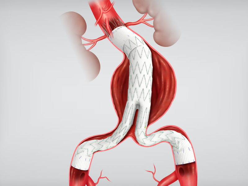Zenith Flex AAA Main Body with Spiral-Z Legs in Anatomy