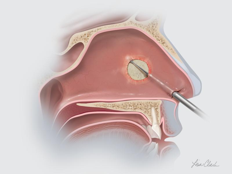Sinonasal Nasal Septal Perforation Product Page Image
